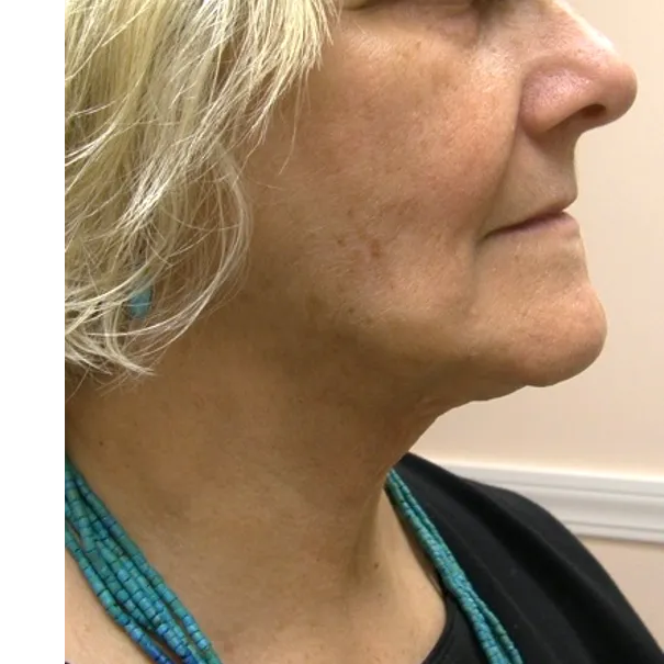 ThermiTight, neck and jawline, after