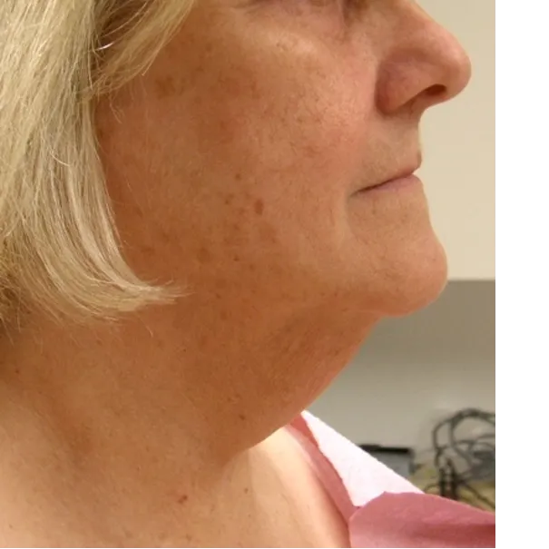 ThermiTight, neck and jawline, before
