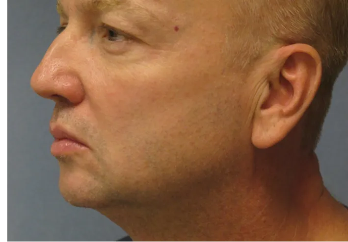 ThermiTight, neck and jawline, after