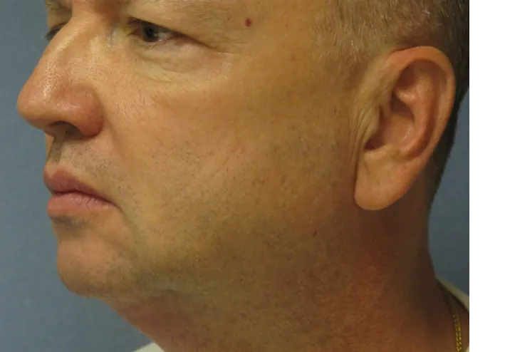 ThermiTight, neck and jawline, before