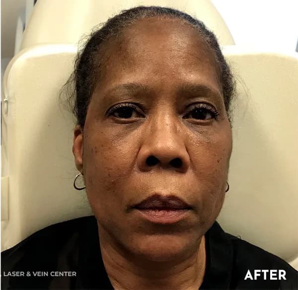 Thread lift, mid-face and cheeks, after