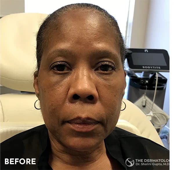 Thread lift, mid-face and cheeks, before