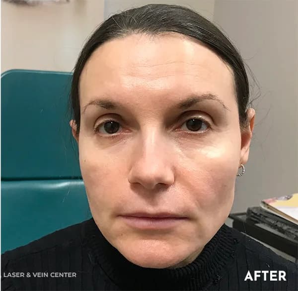 Thread lift, mid-face, after