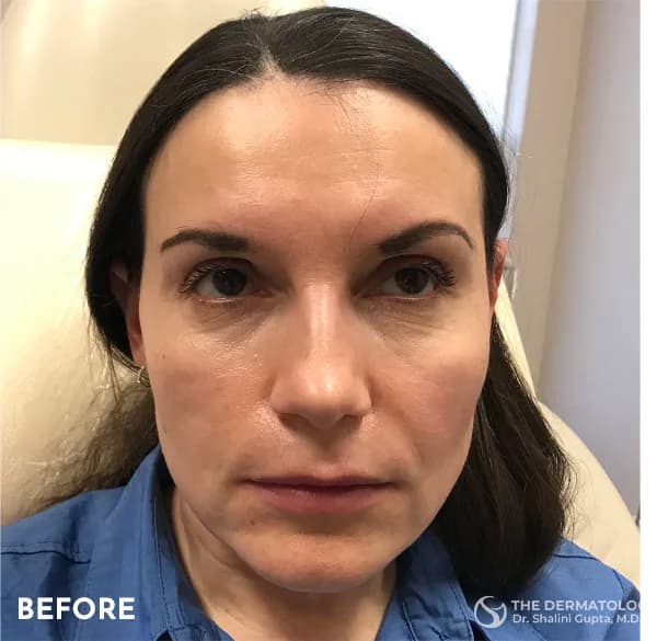 Thread lift, mid-face, before