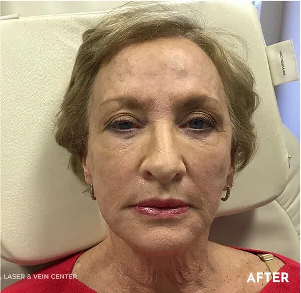 Thread lift, cheeks and jawline, after