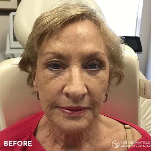 Thread lift, cheeks and jawline, before