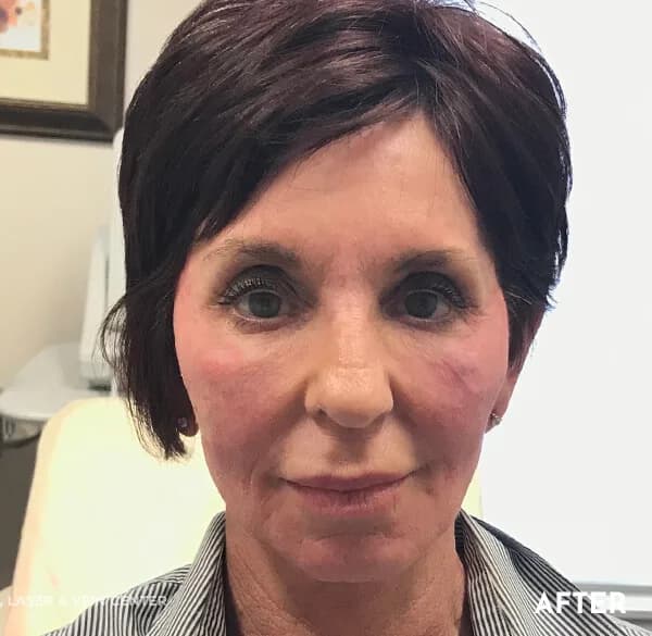 Thread lift, cheeks and jowls, after