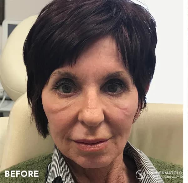 Thread lift, cheeks and jowls, before