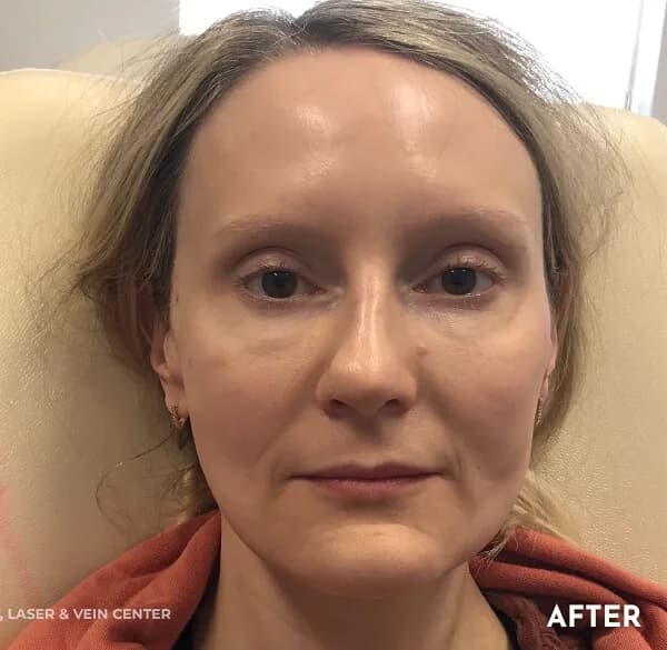 Thread lift, mid-face, after