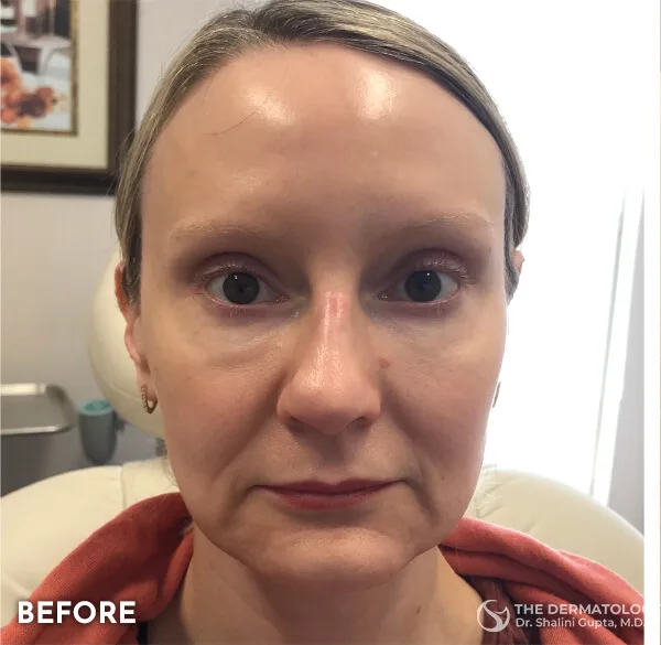 Thread lift, mid-face, before