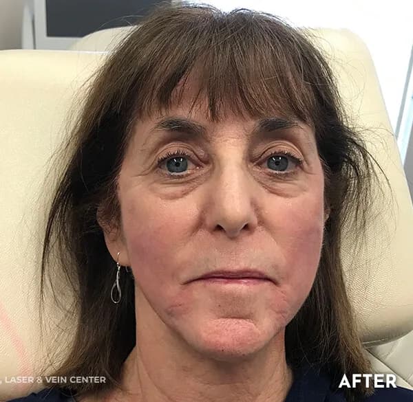Thread lift, lower face and jowls, after