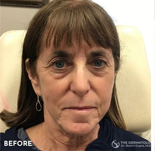 Thread lift, lower face and jowls, before