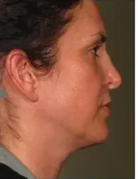 Ultherapy, chin profile, 90 days after treatment, after