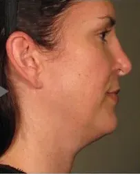 Ultherapy, chin profile, 90 days after treatment, before