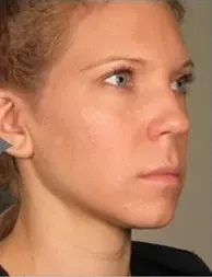Ultherapy, lower face, 180 days after treatment, after