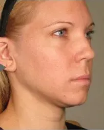 Ultherapy, lower face, 180 days after treatment, before