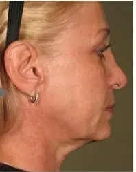 Ultherapy, lower face and neck, 120 days after treatment, after