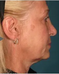 Ultherapy, lower face and neck, 120 days after treatment, before