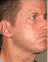 Ultherapy, jawline, male patient, after
