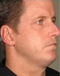 Ultherapy, jawline, male patient, before