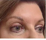 Ultherapy, brow and eye area, after