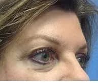 Ultherapy, brow and eye area, before