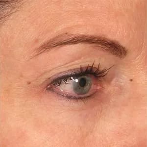 Ultherapy brow lift, 180 days after treatment, after