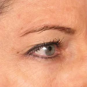 Ultherapy brow lift, 180 days after treatment, before
