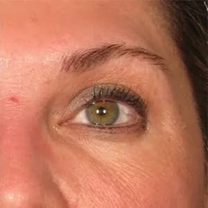Ultherapy brow lift, 450 days after treatment, after