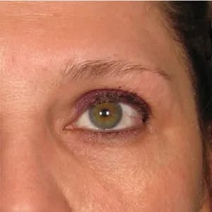Ultherapy brow lift, 450 days after treatment, before