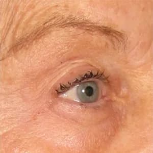 Ultherapy brow lift, 180 days after treatment, after