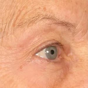 Ultherapy brow lift, 180 days after treatment, before