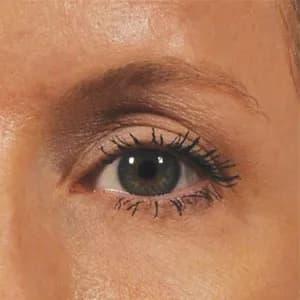 Ultherapy brow lift, 70 days after treatment, after