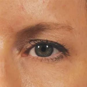 Ultherapy brow lift, 70 days after treatment, before
