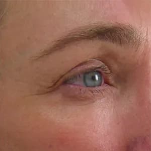 Ultherapy brow lift, 120 days after treatment, after