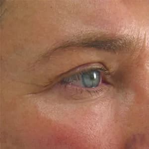 Ultherapy brow lift, 120 days after treatment, before
