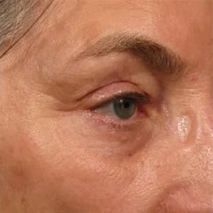 Ultherapy brow lift, 90 days after treatment, after