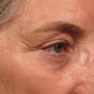 Ultherapy brow lift, 90 days after treatment, before