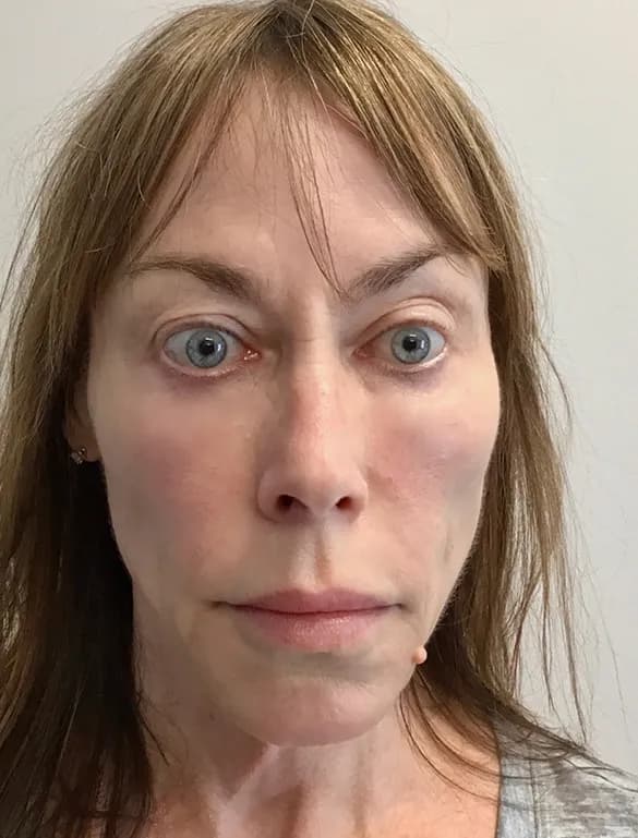 Ultherapy, full face, front view, after