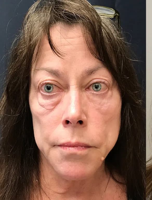 Ultherapy, full face, front view, before