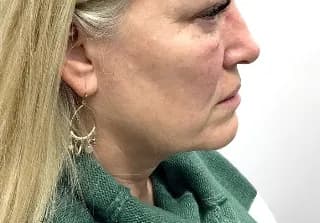 Ultherapy, cheeks and jawline, side view, after