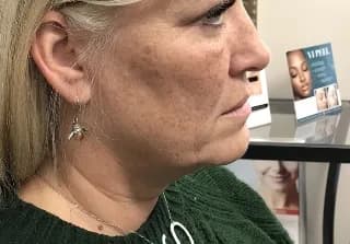 Ultherapy, cheeks and jawline, side view, before