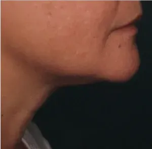 Ultherapy, chin and neck, 120 days after treatment, after
