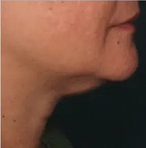 Ultherapy, chin and neck, 120 days after treatment, before