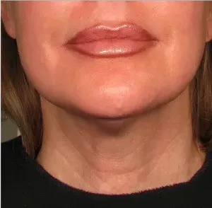 Ultherapy, chin and neck, 90 days after treatment, after