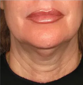Ultherapy, chin and neck, 90 days after treatment, before