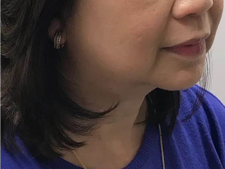 Ultherapy, jawline and neck, after