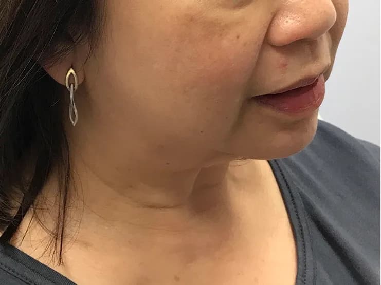 Ultherapy, jawline and neck, before