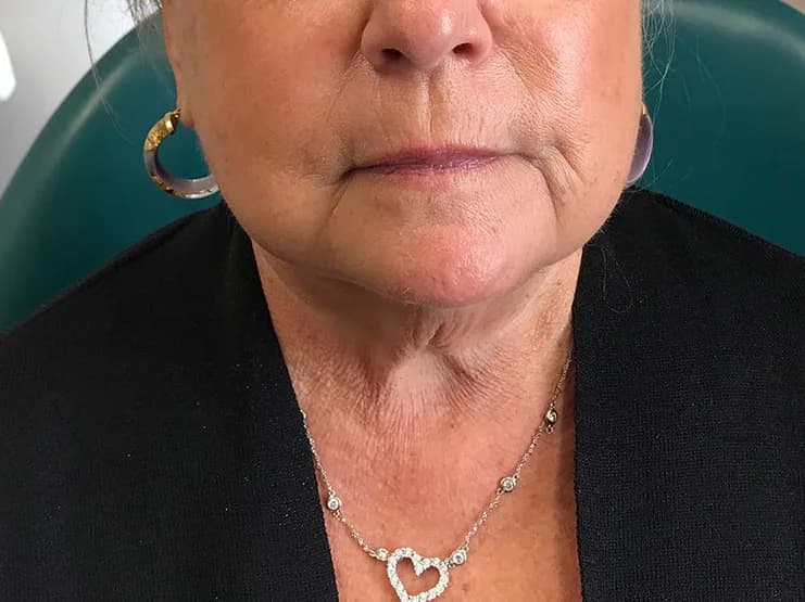 Ultherapy, lower face and neck, after