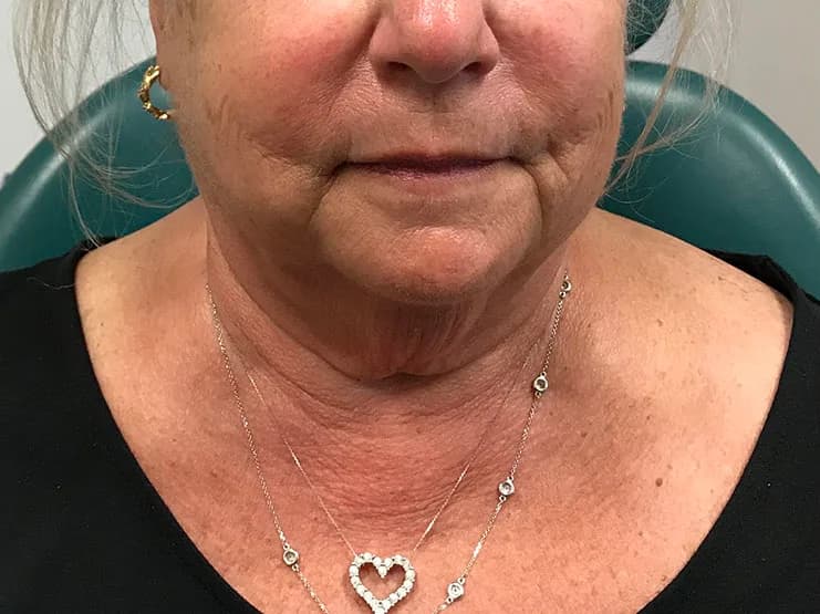 Ultherapy, lower face and neck, before